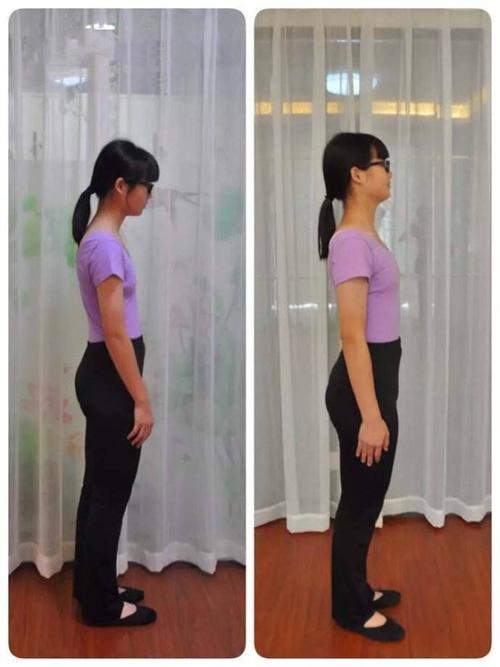 宜宾体格锻炼 青少年含胸驼背,体态调理课程 我国小学生,青少年脊柱侧