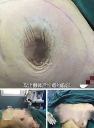 深圳隆胸假体取出好医院盘点隆胸失败修复不踩坑
