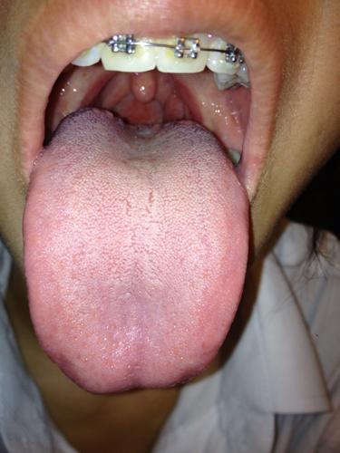 请问我的舌头正常吗?舌根后面有红红的疙瘩请问那是什么?