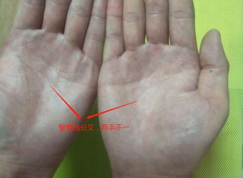智慧线分叉,且两手纹路差别大
