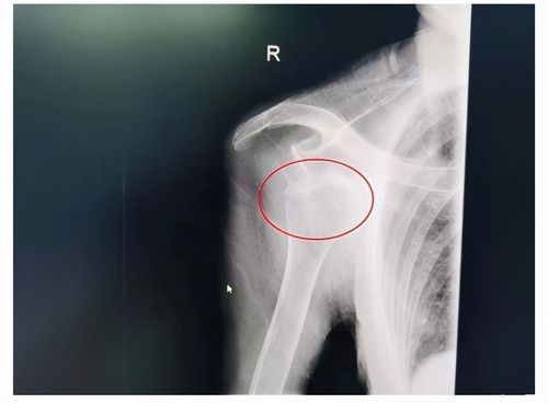 肩关节脱位x光片