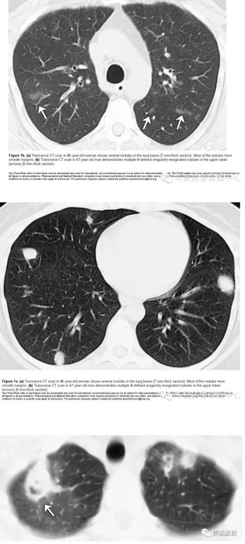 表现为多发结节的肺隐球菌病1例ct影像