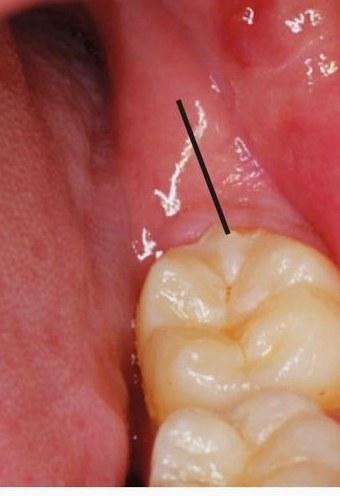 【图】智齿拔除术切口的类型