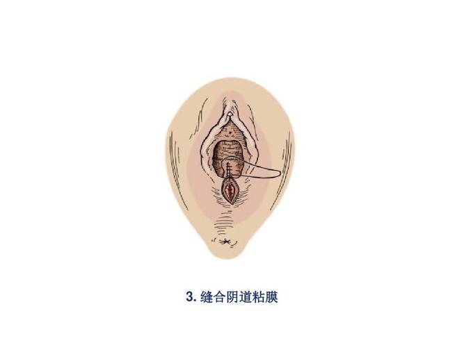 (医学课件)会阴裂伤缝合新进展ppt演示课件