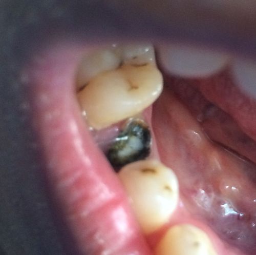 有一颗牙根一直烂在里面5,6年了,怎么办,可以壤牙吗?