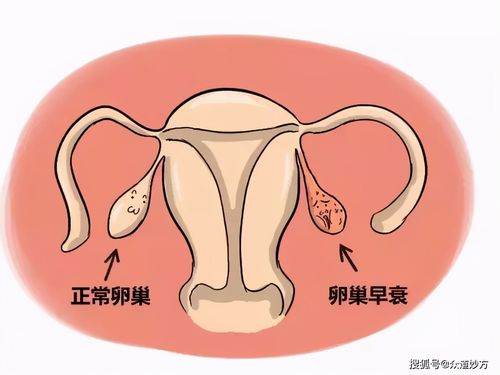 女性卵巢早衰需警惕