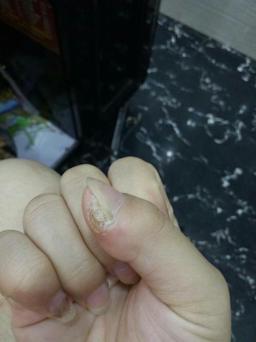 求问我这手指是咋回事?上面是死皮可以剪,剪完过一阵又会想出来
