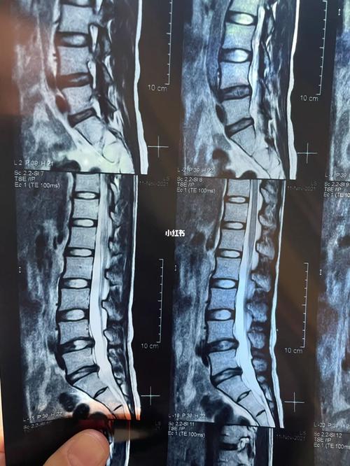 腰椎间盘突出,崩溃中自愈,自愈后又崩溃_腰间盘突出_自如怎么样_腰痛
