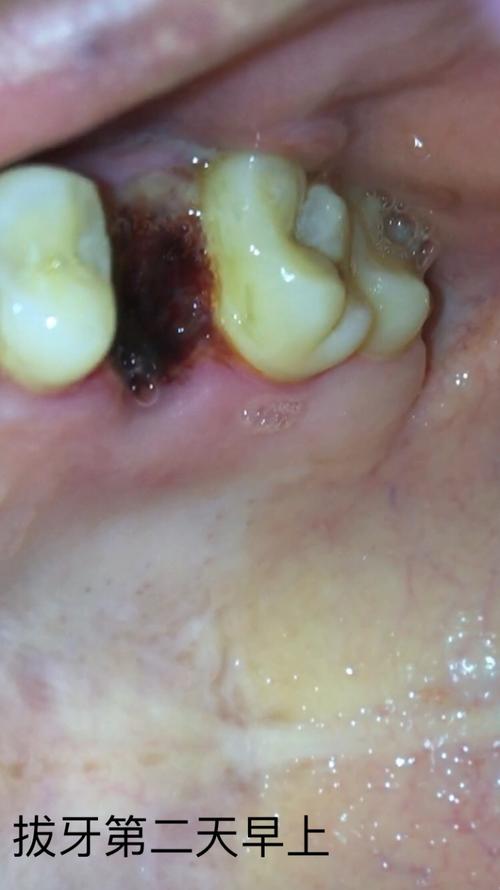 拔牙全程(多图慎点!)恢复期全过程