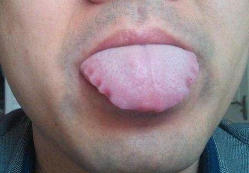 脾胃虚寒的人,舌头可能会有4种"异常",不妨提前了解