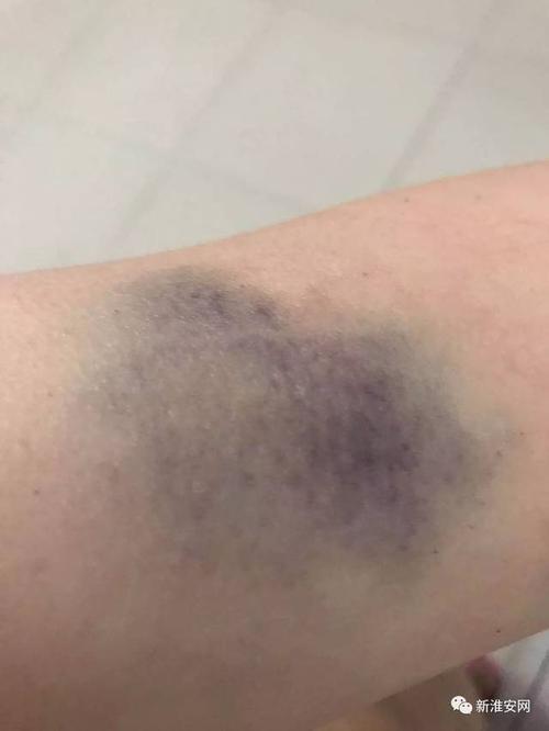 死者生前被打淤青照片流出.淮安26岁妈妈携儿喝农药