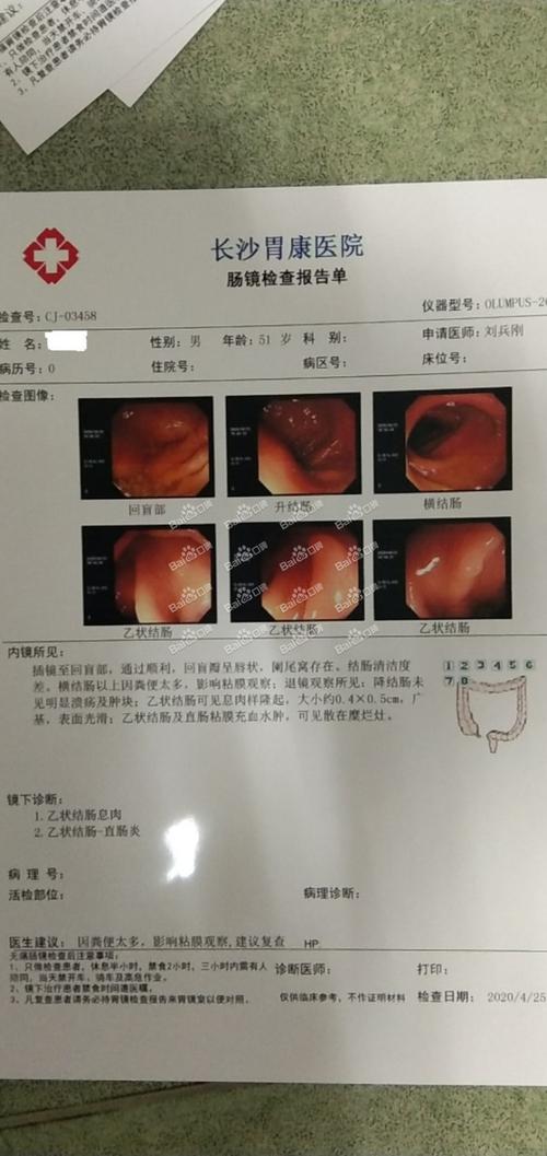 鼓起来像个球一样,吃药不管用,才去医院检查一下,发现是结肠息肉,就割