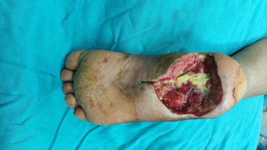 糖尿病足––之足溃烂的重生