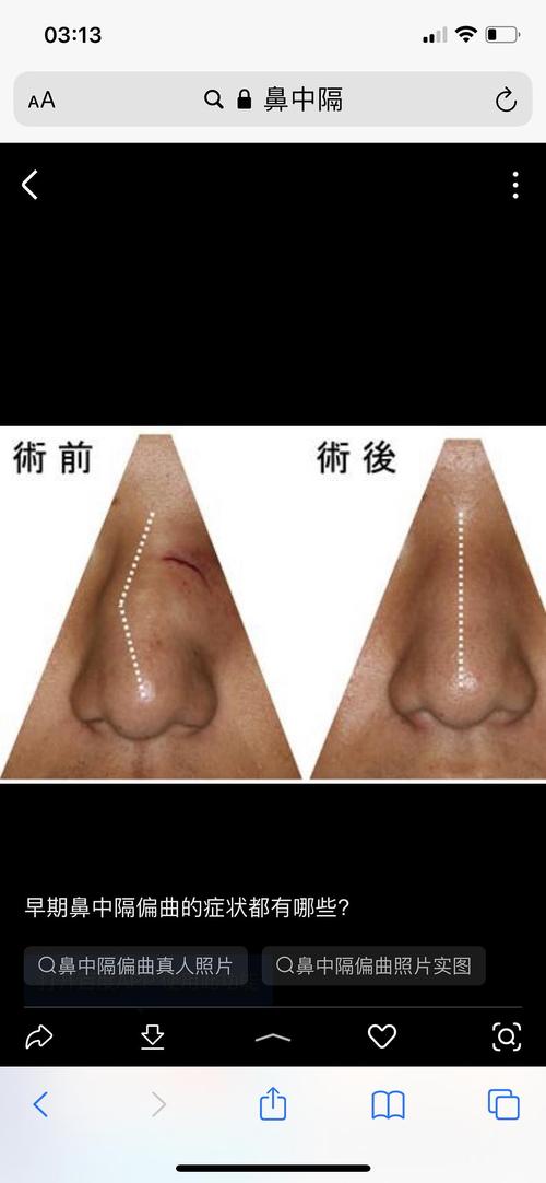 我这是鼻中隔偏曲吗