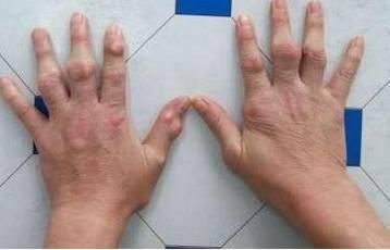 痛风的症状