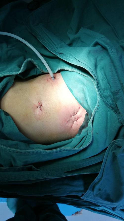 后腹腔镜下技术也已成为我院肾脏及输尿管手术的主要方法,大大缩短了