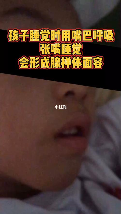 腺样体面容出现,是长期这样睡觉的结果_腺样体肥大_母婴_育儿经验