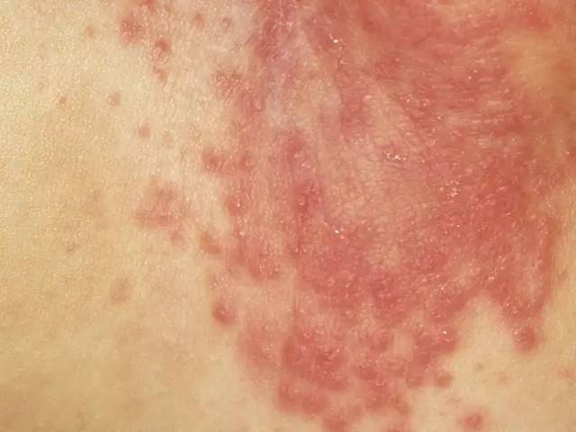 尿布疹的早期症状通常是在臀部,生殖器,腹股沟等长期被尿片覆盖的地方