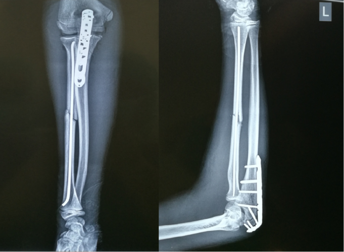 左侧桡骨干合并尺骨鹰嘴骨折手术治疗分享
