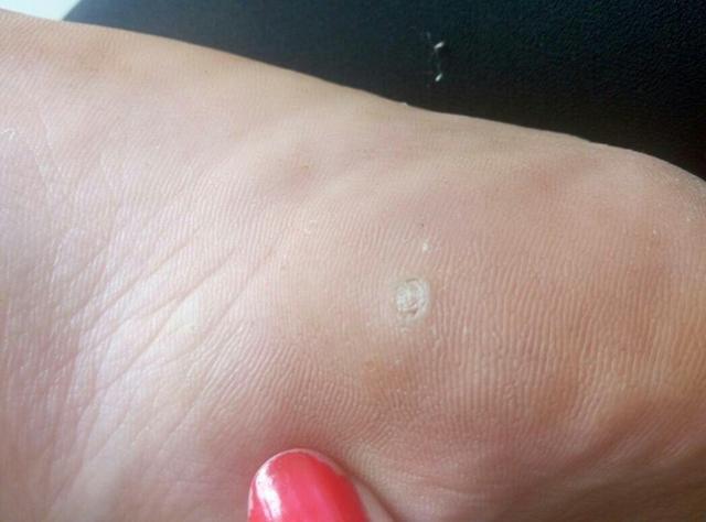 跖疣是脚掌处类似老茧的皮损多不会恶变具有传染性