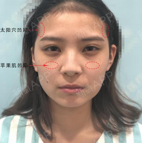 面部凹陷怎么办?