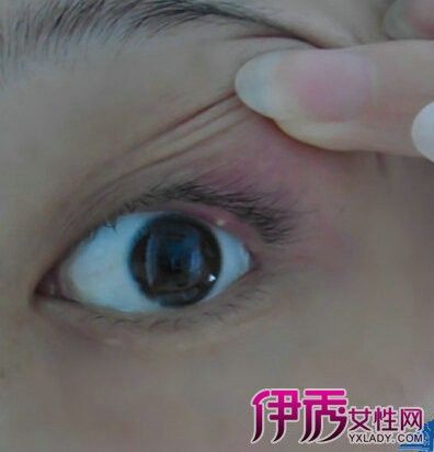 【图】什么是麦粒肿图片 让小编为你揭开它对人体的危害