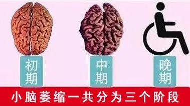 被忽悠的小脑萎缩与脑供血不足