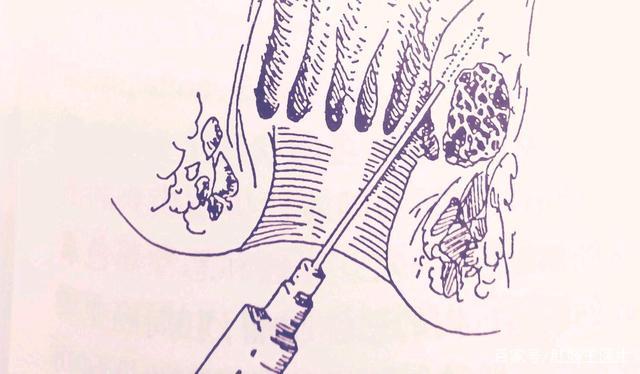 一般是采用内痔注射术,也就是在痔核和痔核上方注射一种硬化剂,造成痔