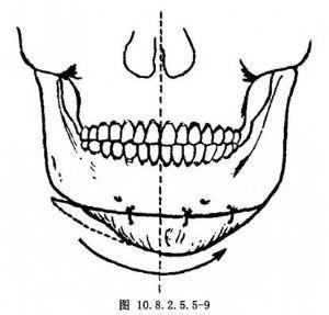 颏部偏斜矫正术