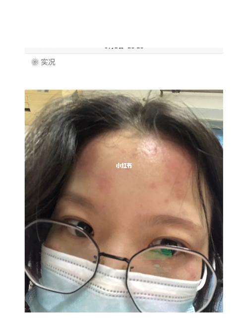 接触性皮炎后脸部如何修复图片恶心慎入