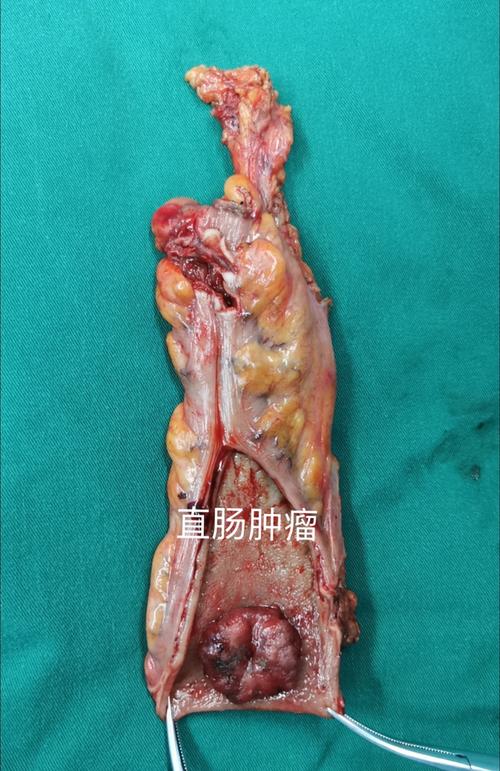 直肠肿瘤