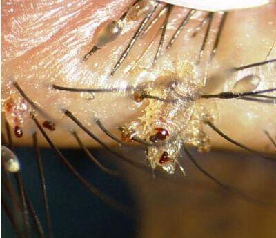 阴虱病如何防治?