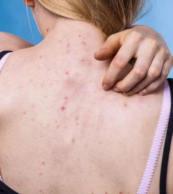 身体夏天美背计划痘痘鸡皮肤晒黑我一个都不要