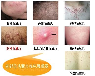 皮肤专家全面解析:毛囊炎