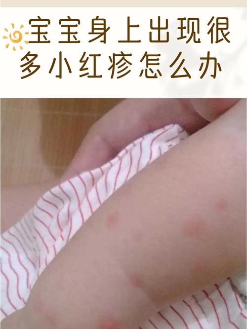 这些小红疹不仅影响宝宝的外观,还可能让宝宝难以安睡,甚至影响食欲