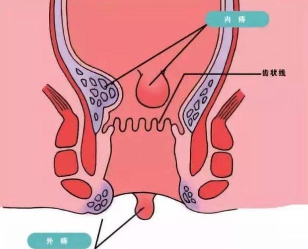 肛门附近长出了肉疙瘩?或许是一个原因在作怪,千万别大意!