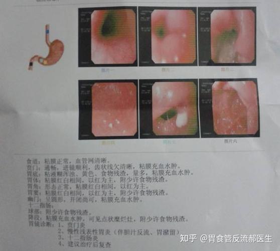 浅表性胃炎的症状都有哪些患上浅表性胃炎可以喝牛奶吗