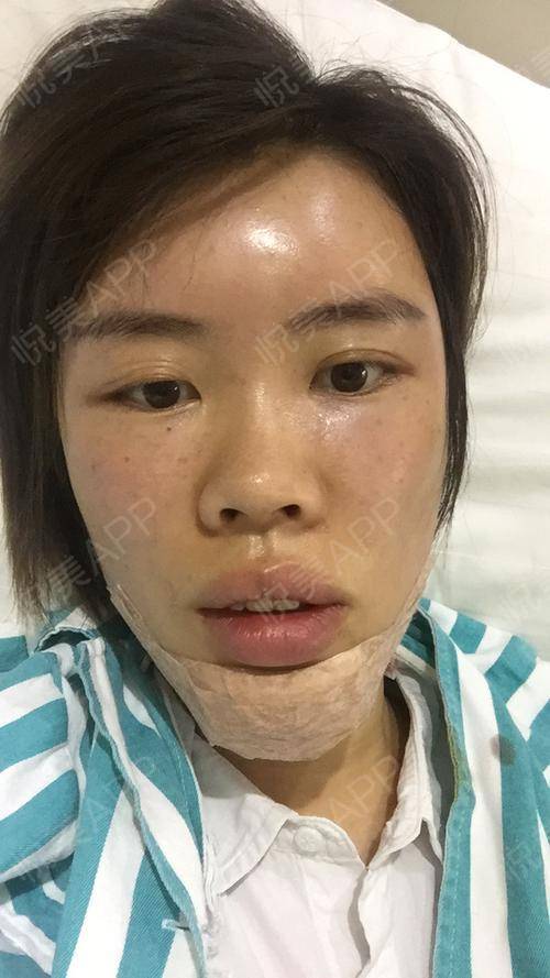 硅胶假体垫下巴手术当天_垫下巴手术当天_面部轮廓手术当天_爱做饭的