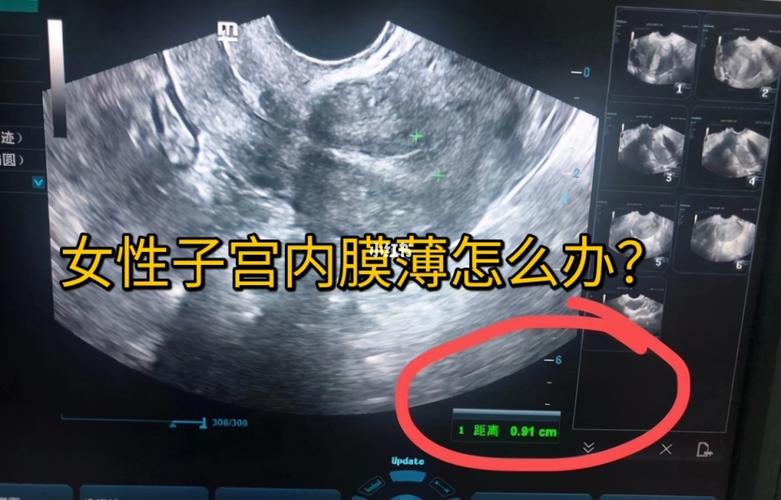 干货女性子宫内膜薄怎么办怎么调理