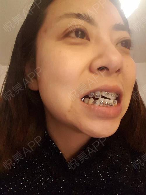 像生孩子,洗胃 ,一两项小手术等,反而对于牙齿正畸这件事情上就不是