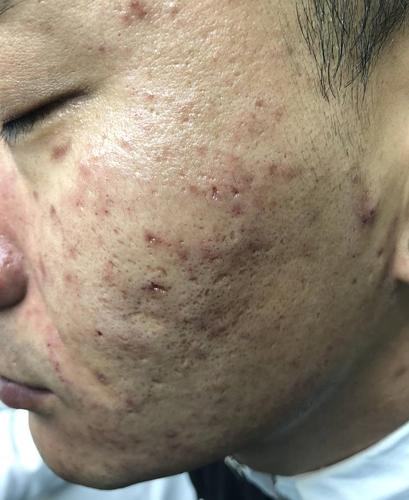 康痘士专业祛痘教你怎么区分红痘印与黑痘印