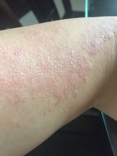 很痒,气温底一点就消失的无影无踪,医院看过说是紫外线过敏