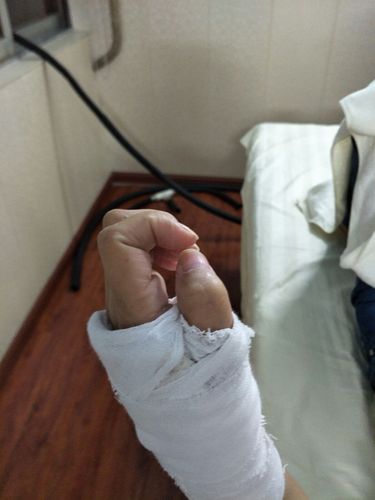 林莲菊,摔伤左手桡骨远端骨折病例