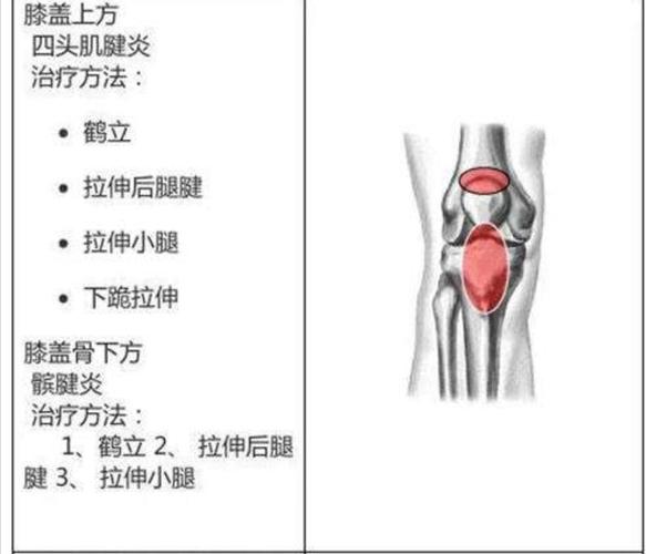 肌腱炎, 髌骨,腘绳肌,股四头肌肌腱炎和髂胫束综合症
