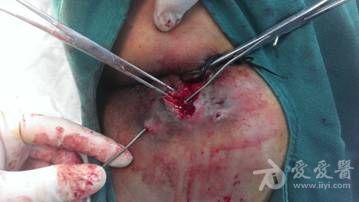 低位复杂性肛瘘一例