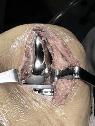 左膝关节腔及髌上囊积液,髌上滑膜皱襞增厚.