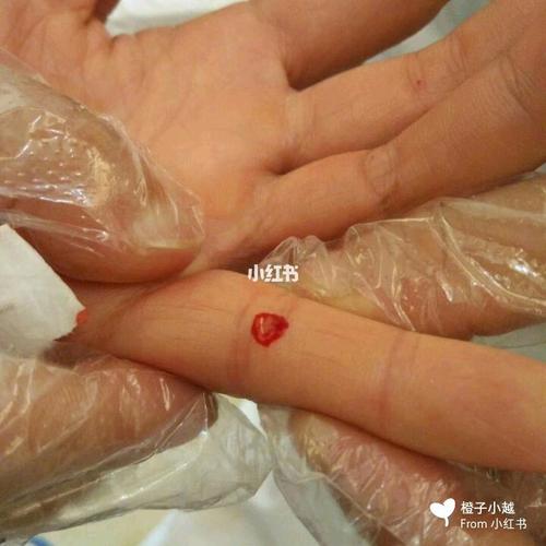 四缝放血(挤四缝)_传承中医文化_医疗健康_医疗方法