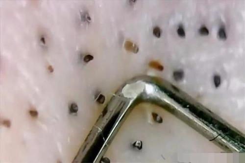 鼻子上有黑黑点点困扰?这样做,黑头不在皮肤光滑