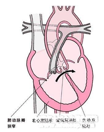 法洛四联症的诊断