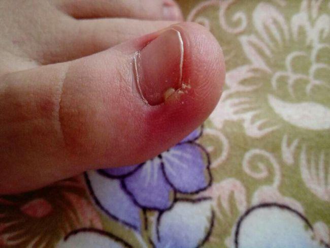脚趾甲总往肉里钻怎么办教你一个小妙招甲沟炎或慢慢好转